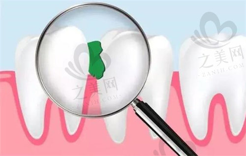 经常塞牙缝或许是牙齿发出的求救信号