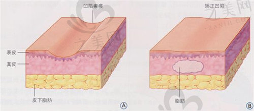 项利姣脂肪填充怎么样