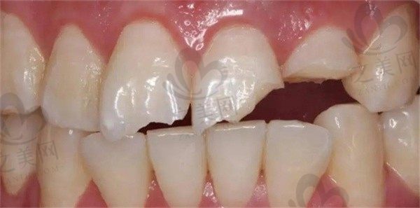牙齿磕伤怎么处理会好得快一点儿?真的需要拔牙吗?