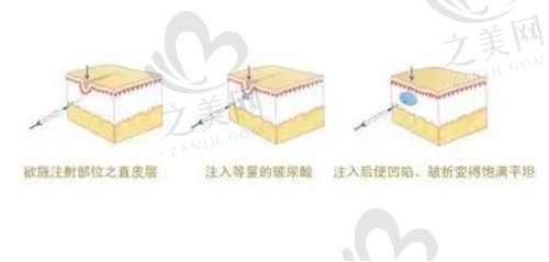 上海薇琳赵岩医生做提升技术好不好