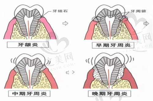 牙周炎发展过程