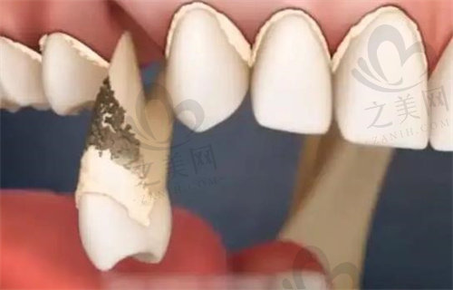 牙周疾病造成牙齿脱落