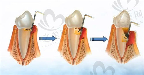 深牙周袋发展过程