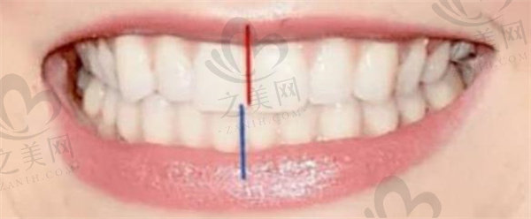 牙齿中线不齐调整前后对比图