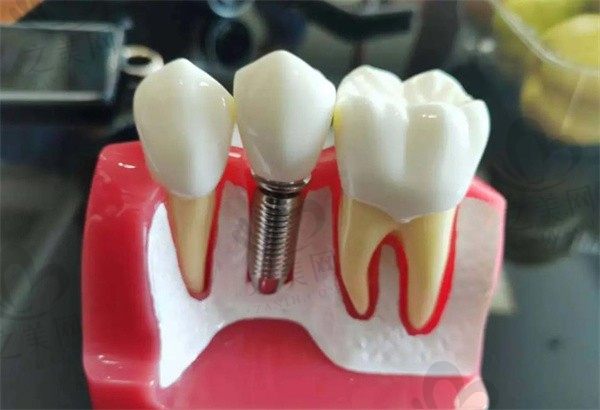 想要种牙但是拔牙和种牙不在同一家医院可以吗?得多少钱?