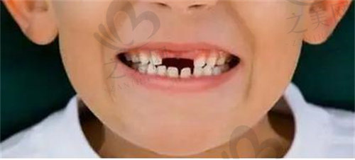 换牙期乳牙脱落情况会影响后续恒牙发育