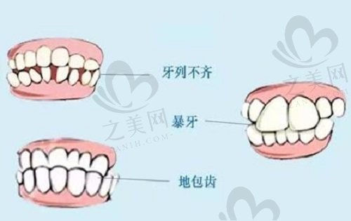 牙齿矫正畸形情况