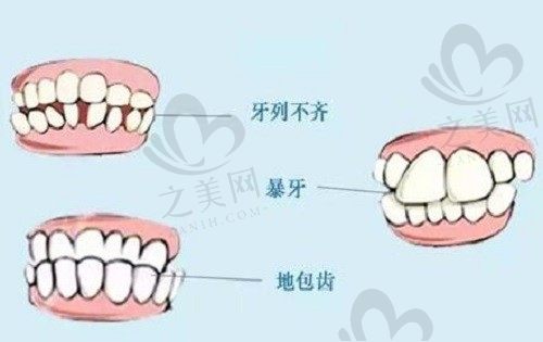 带牙套影响做下颌角手术吗?戴牙套做轮廓的注意事项你得了解