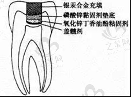 盖髓术