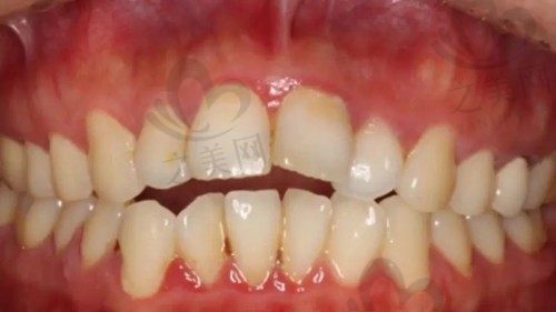 盖髓术和根管治疗哪个好?干髓治疗和根管治疗区别