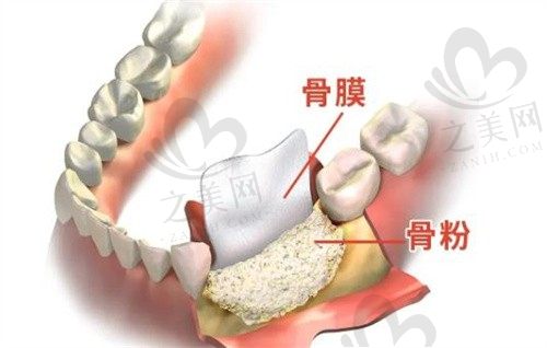 骨粉骨膜是什么?种植一颗牙还需要什么其他费用?