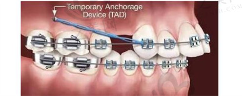 牙齿矫正的支抗钉有什么作用？