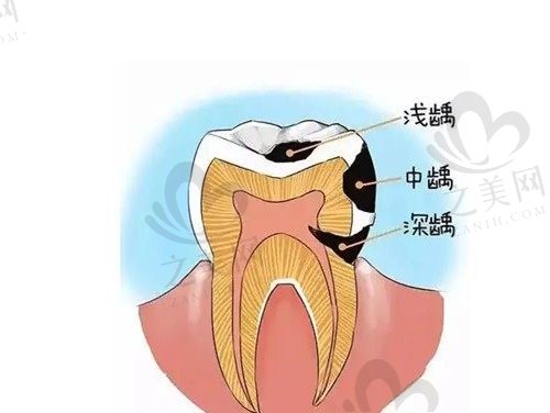 牙齿上有虫洞,吃饭酸疼怎么办?解答这样的牙齿非拔不可吗