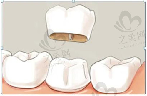 冠修复里面的真牙需提前打磨