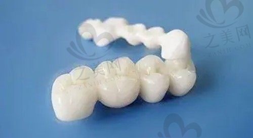 门牙为什么不建议做全瓷牙?门牙做全瓷牙的缺点要知道