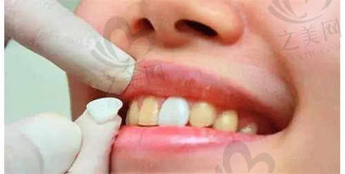 牙齿贴面能够修复变色牙