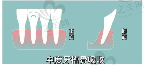 夜磨牙可能会导致牙槽骨吸收