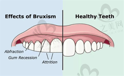 磨牙症会使牙齿牙窝消失影响咀嚼
