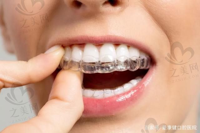 国产正雅和美立刻哪个好?解析这两种牙套价格和区别