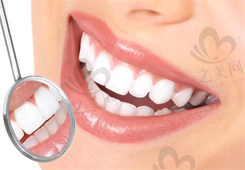 牙贴面可恢复牙齿洁白完整