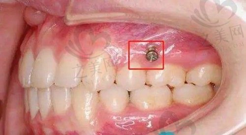 为什么医生不建议牙齿打骨钉?一秒读懂矫正牙齿打骨钉的危害