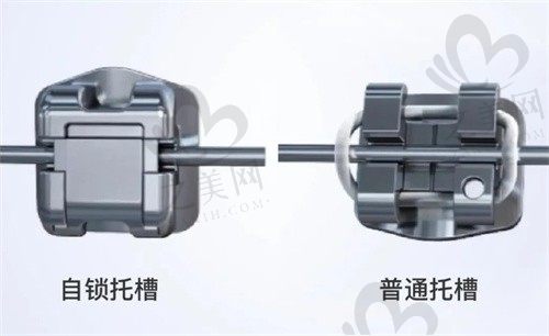 自锁真的比普通的好嘛?为什么医生建议选自锁托槽矫正?