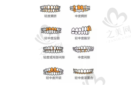 牙齿不齐的几种常见情况