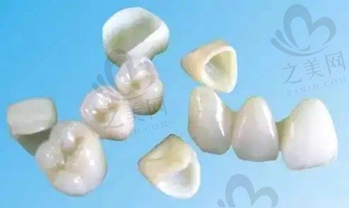 是烤瓷牙好还是全瓷牙好?1000元的全瓷牙和1500的区别