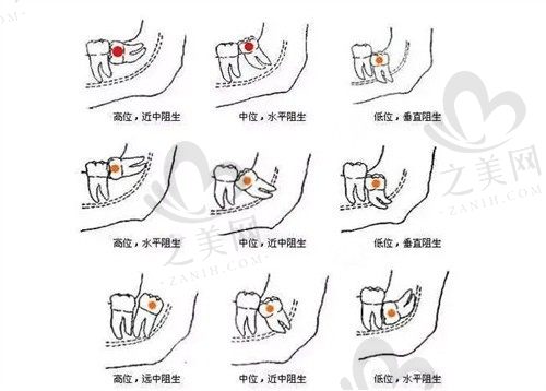 牙齿不齐和智齿有关吗?牙友反馈拔了智齿龅牙消失了