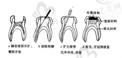 根管治疗过程