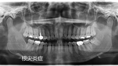 根尖炎概念