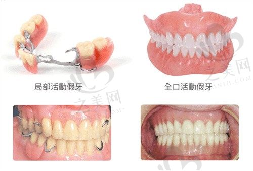 后槽牙没有了怎么镶牙?年轻人镶固定义齿好吗?过来人分享