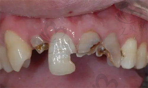 患者口内的残冠牙