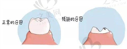 残根牙必须马上拔掉吗?解答牙齿残根20几年了不痛该不该拔