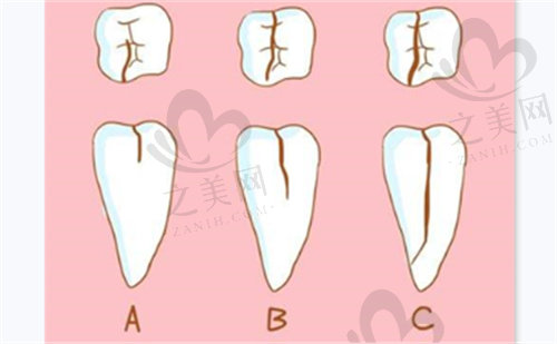 牙隐裂的几种程度