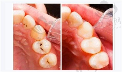 浅龋补牙实际更是损害牙?为什么说窝沟黑线补完牙很后悔