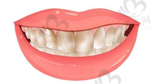 氟斑牙和脱矿怎么区分?公开氟斑牙的科学修复方法