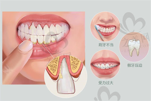 牙龈萎缩的病因及表现