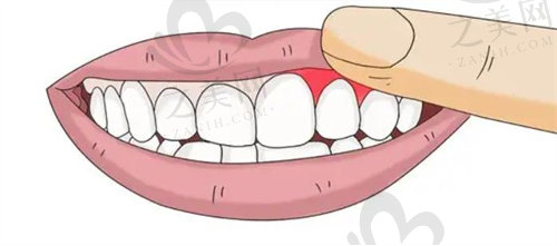 牙龈萎缩防治很重要