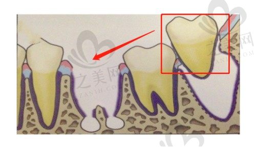 自体牙齿移植成功率高吗能用多久?如果移植失败可以不拔掉吗