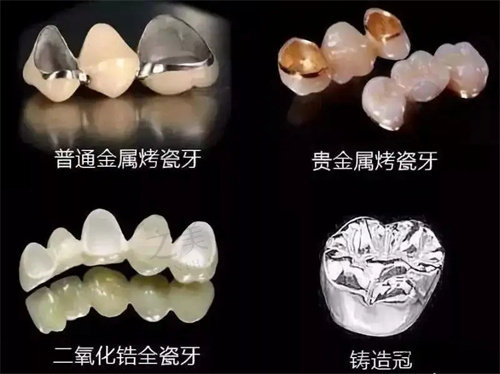 166全瓷牙与其他牙冠的区别