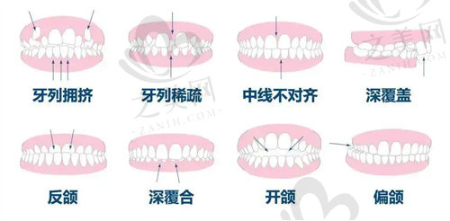 各种类型的牙齿畸形导致的咬合不正