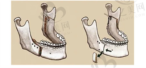 骨性畸形需要正颌手术来矫正