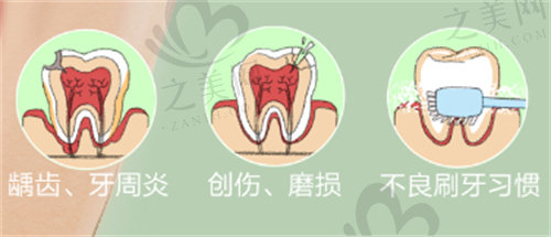 牙髓炎病因