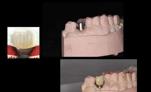 种植牙愈合基台作用