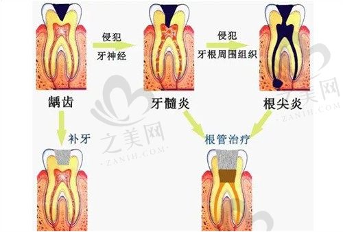 牙髓炎3分钟自愈方法公开!牙髓炎不治的后果,可以自动好吗