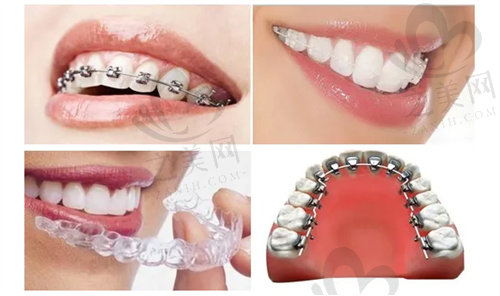 几种常见的牙套