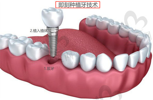 即拔即种图解