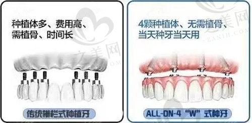 all-on-4种植优点