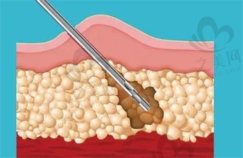 杭州格莱美彭涛医生抽脂口碑佳，负压腰腹吸脂塑形好价格11980元起